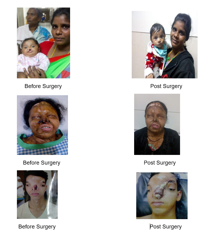Restoring Hope and Transforming Lives: Lions' Plastic Surgery Initiative Restoring Hope and Transforming Lives: Lions' Plastic Surgery Initiative